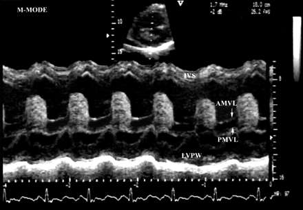 Atrialis thrombus primer