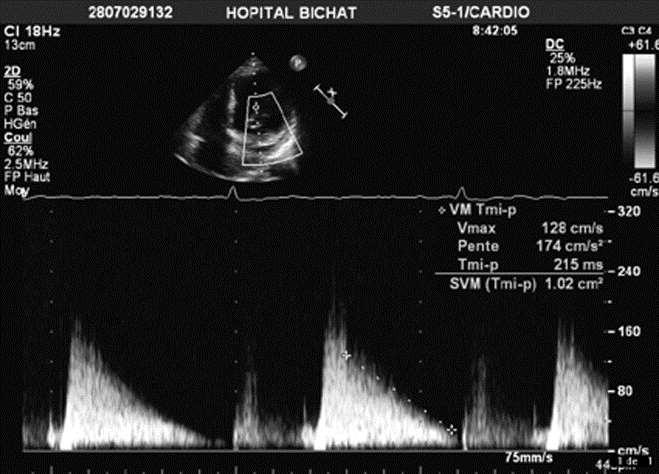 Pressure half-time T 1/2 = time interval in milliseconds between the maximum mitral gradient in