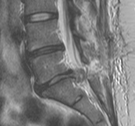 Cauda equina szindróma medialis lumbalis gerincsérv mely tünetei: