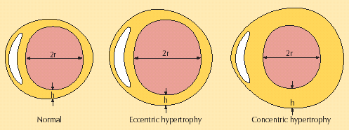 Haemodinamikai következmények Volumenterhelés Tág bal kamra, bal pitvar Excentrikus hypertrophia Emelkedett