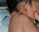 Az újszülött morfológiai anomáliái a tarkótájon mélyen lenőtt haj