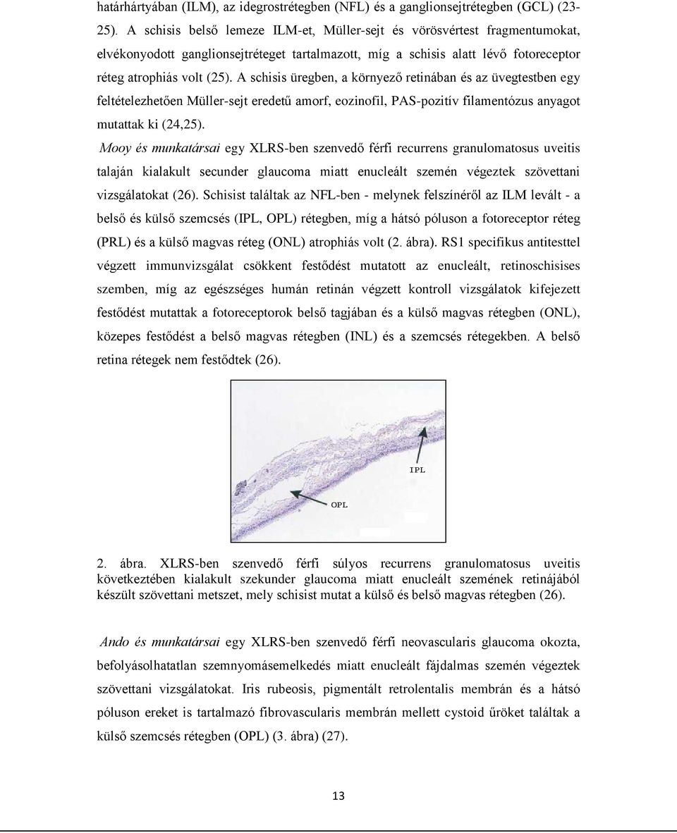 A schisis üregben, a környező retinában és az üvegtestben egy feltételezhetően Müller-sejt eredetű amorf, eozinofil, PAS-pozitív filamentózus anyagot mutattak ki (24,25).