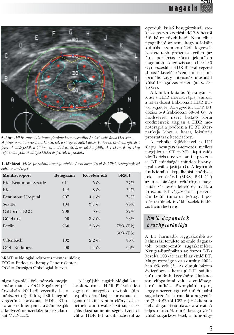 HDR prosztata brachyterápiás dózis kiemeléssel és külsõ besugárzással elért eredmények Munkacsoport Betegszám Követési idõ brmt Kiel-Beaumont-Seattle 611 5 év 77% Kiel 144 8 év 74% Beaumont Hospital