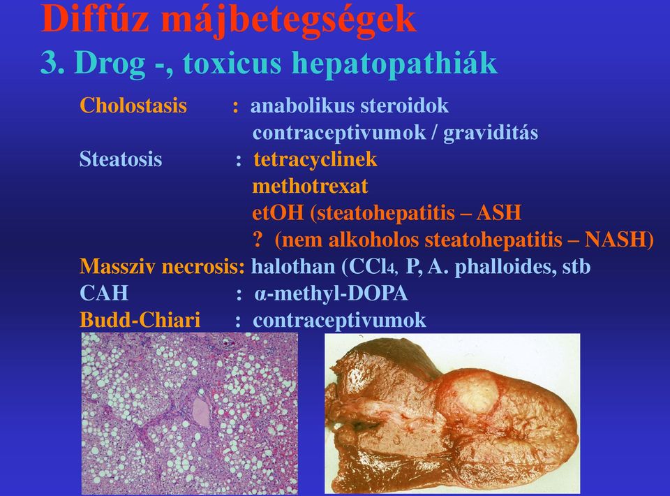 / graviditás Steatosis : tetracyclinek methotrexat etoh (steatohepatitis ASH?