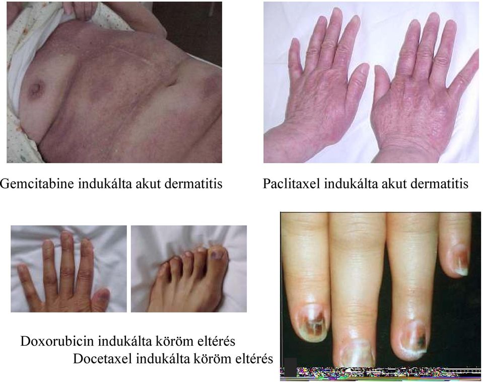 akut dermatitis Doxorubicin