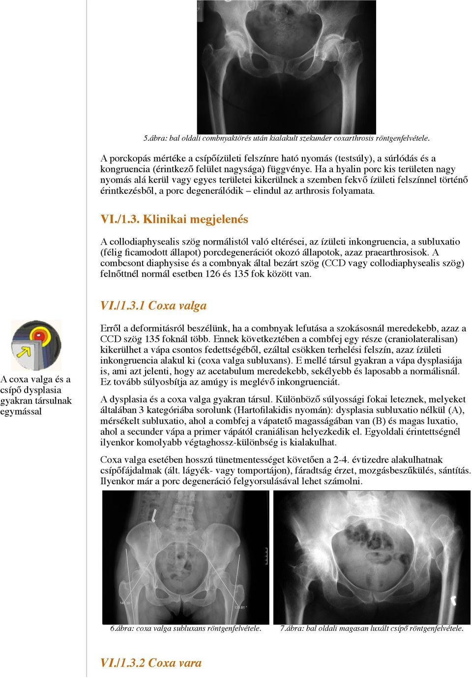 A coxarthrosis kliniko-patológiai típusai* DR. MÉSZÁROS TAMÁS - PDF Free Download