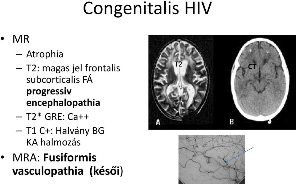 encephalopathia T2* GRE: Ca++ T1 C+: Halvány