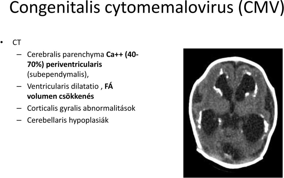 (subependymalis), Ventricularis dilatatio, FÁ volumen