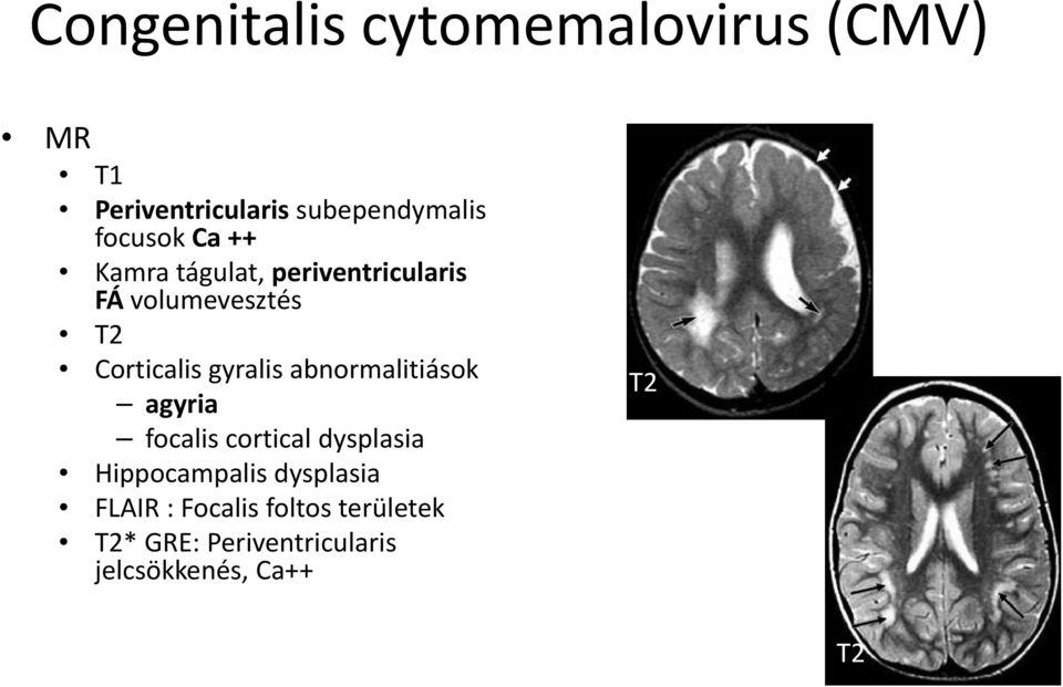 gyralis abnormalitiások agyria focalis cortical dysplasia Hippocampalis