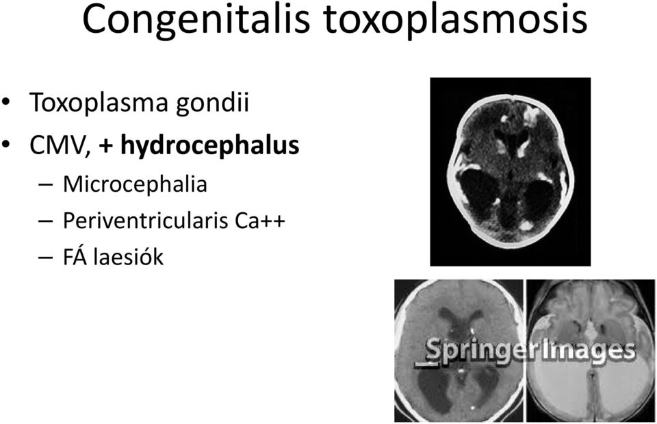 hydrocephalus Microcephalia