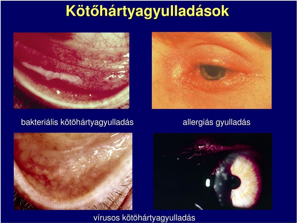 kötőhártyagyulladás