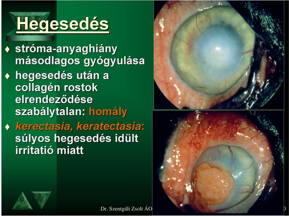 szabálytalan: homály kerectasia, keratectasia: súlyos