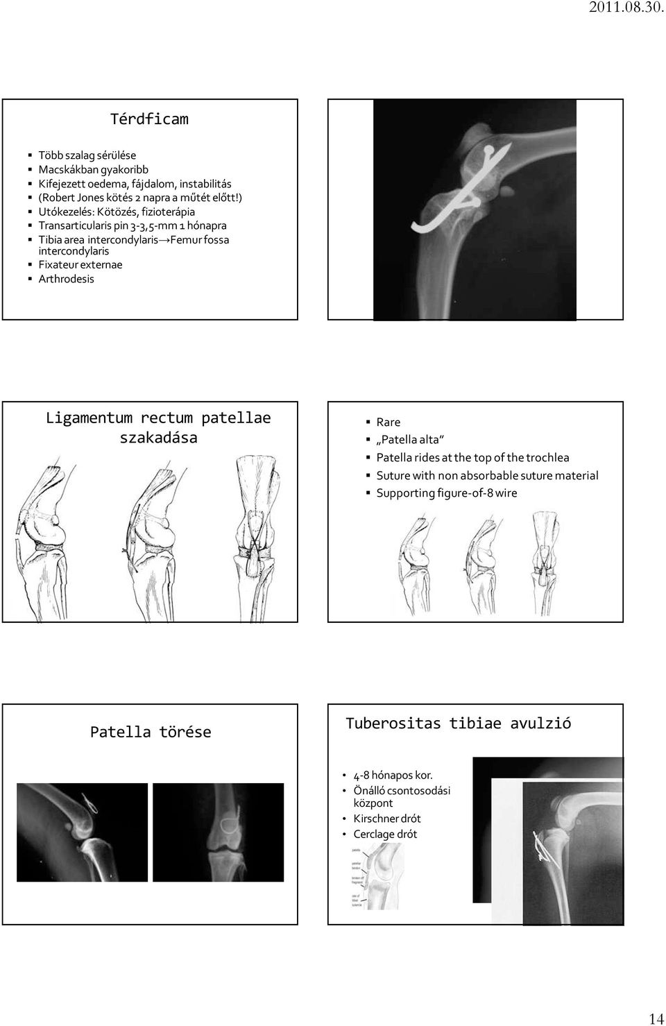 externae Arthrodesis Ligamentum rectum patellae szakadása Rare Patella alta Patella rides at the top of the trochlea Suture with non absorbable