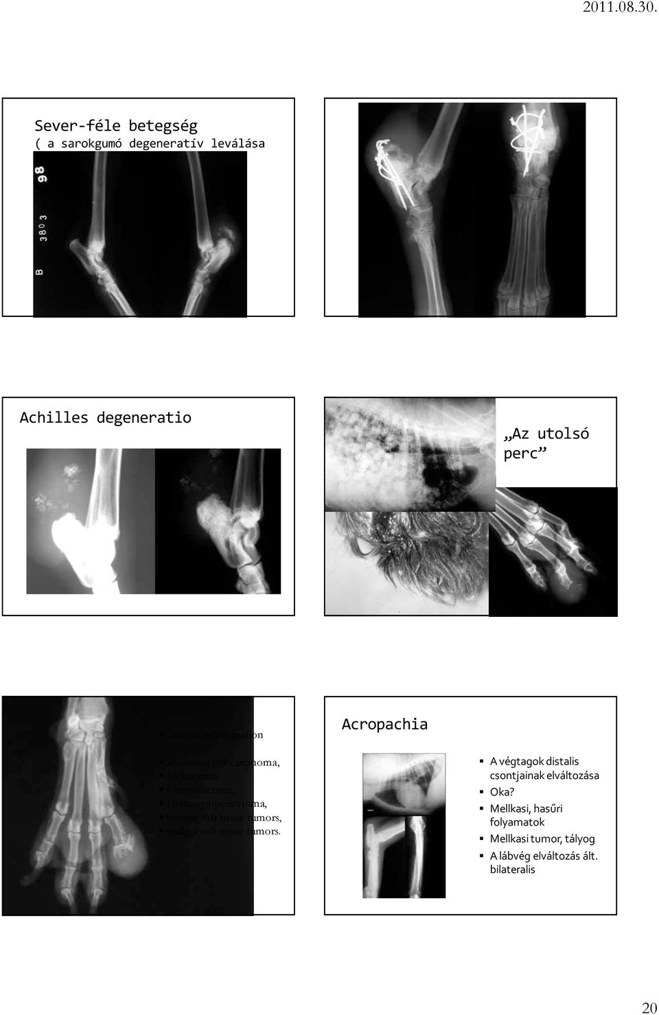 Hemangiopericytoma, benign soft tissue tumors, malign soft tissue tumors.