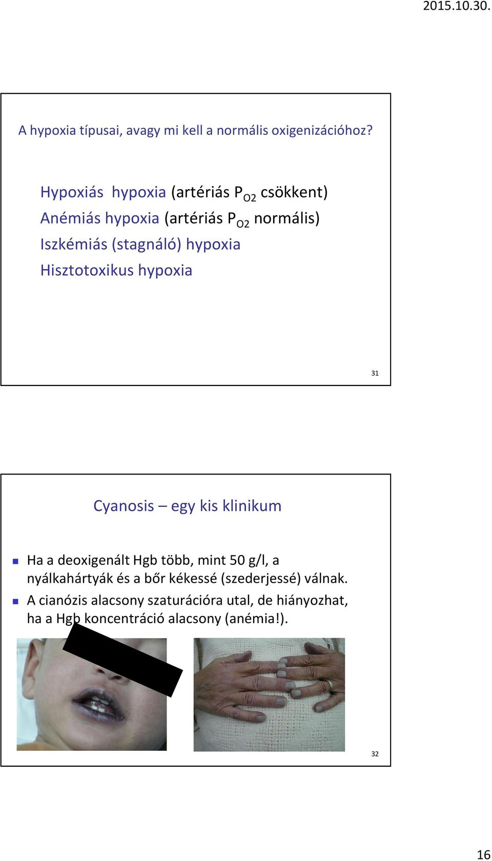 hypoxia Hisztotoxikus hypoxia 31 Cyanosis egy kis klinikum Ha a deoxigenált Hgb több, mint 50 g/l, a