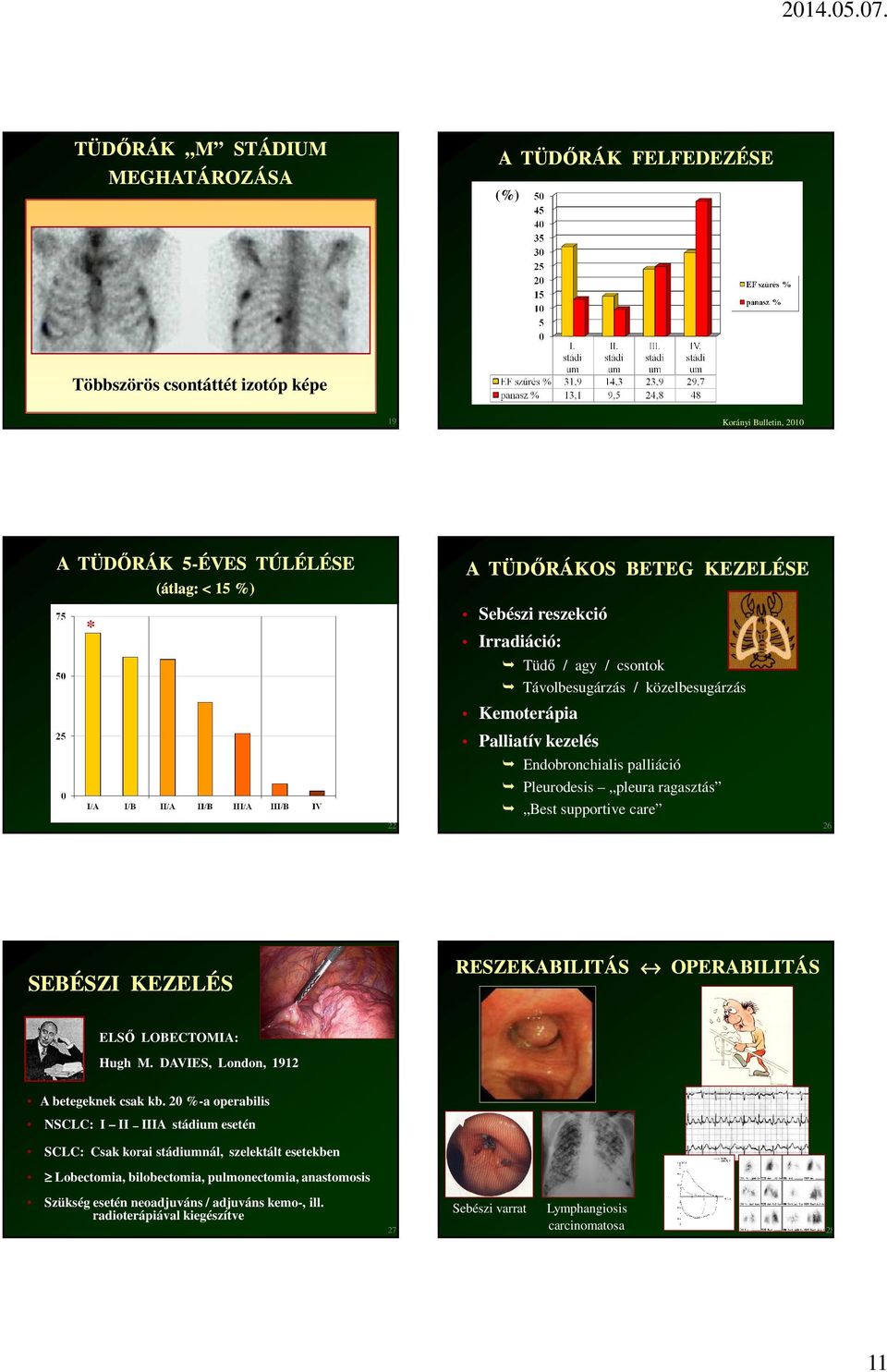 26 SEBÉSZI KEZELÉS RESZEKABILITÁS OPERABILITÁS ELSŐ LOBECTOMIA: Hugh M. DAVIES, London, 1912 A betegeknek csak kb.