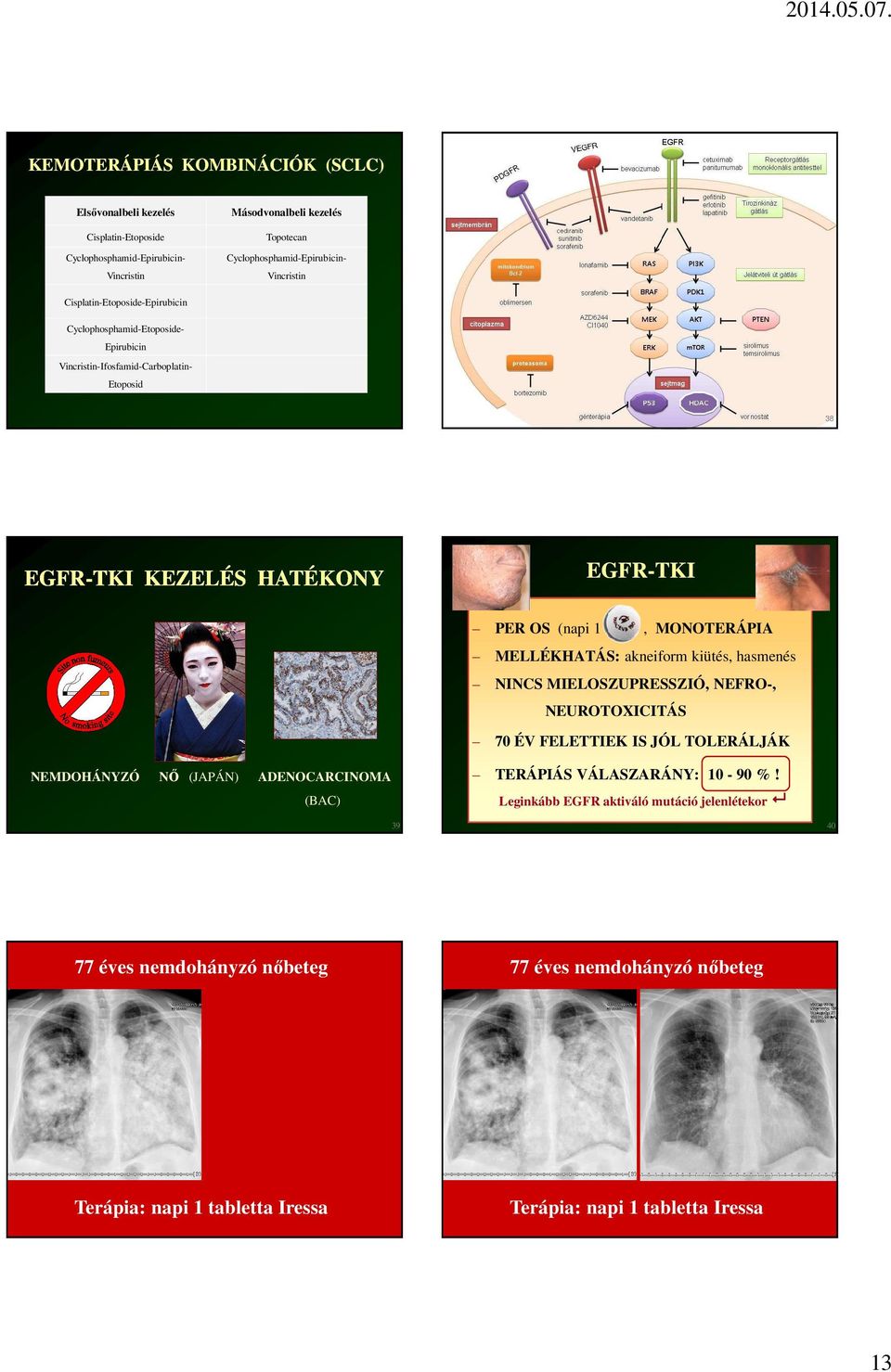 MONOTERÁPIA MELLÉKHATÁS: akneiform kiütés, hasmenés NINCS MIELOSZUPRESSZIÓ, NEFRO-, NEUROTOXICITÁS 70 ÉV FELETTIEK IS JÓL TOLERÁLJÁK NEMDOHÁNYZÓ NŐ (JAPÁN) ADENOCARCINOMA (BAC)