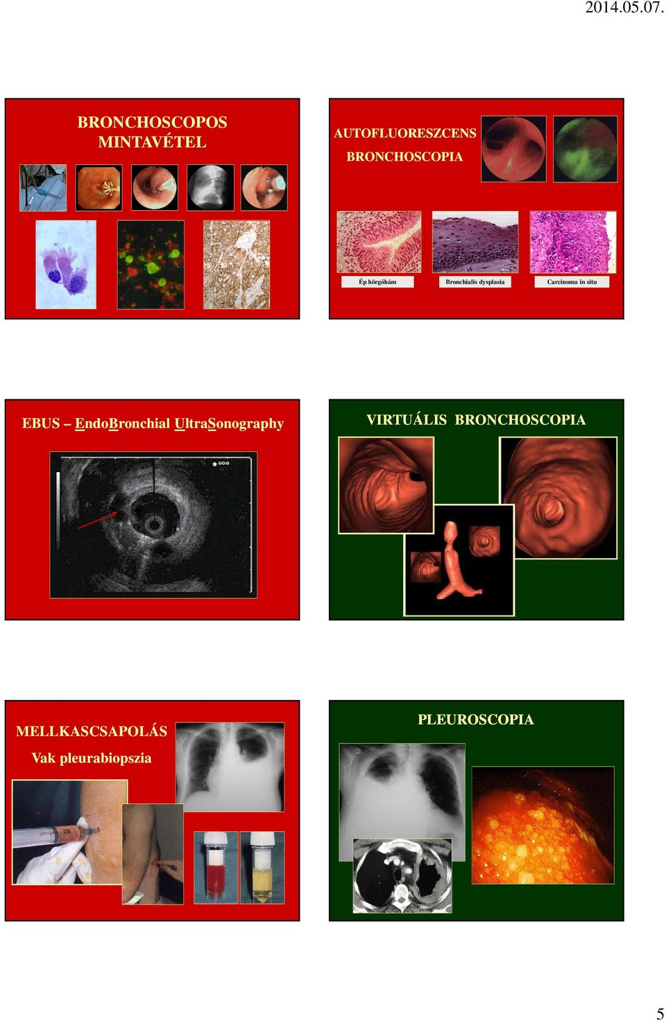 Carcinoma in situ EBUS EndoBronchial UltraSonography