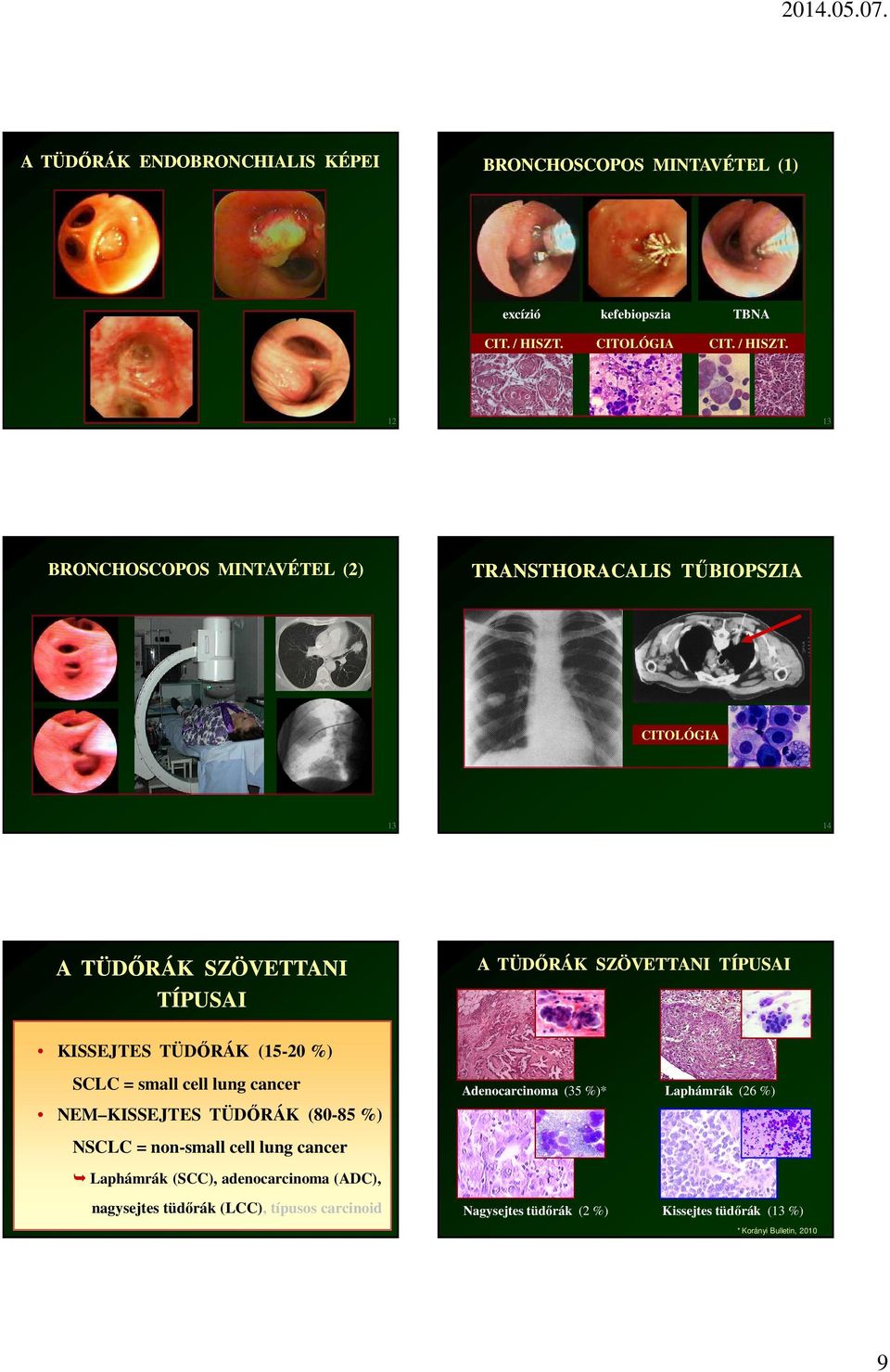12 BRONCHOSCOPOS MINTAVÉTEL (2) 13 TRANSTHORACALIS TŰBIOPSZIA CITOLÓGIA 13 A TÜDŐRÁK SZÖVETTANI TÍPUSAI 14 A TÜDŐRÁK SZÖVETTANI TÍPUSAI KISSEJTES