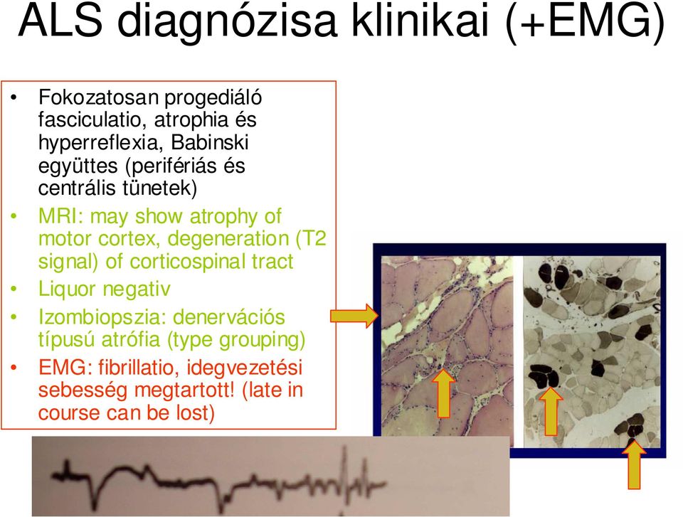 degeneration (T2 signal) of corticospinal tract Liquor negativ Izombiopszia: denervációs típusú