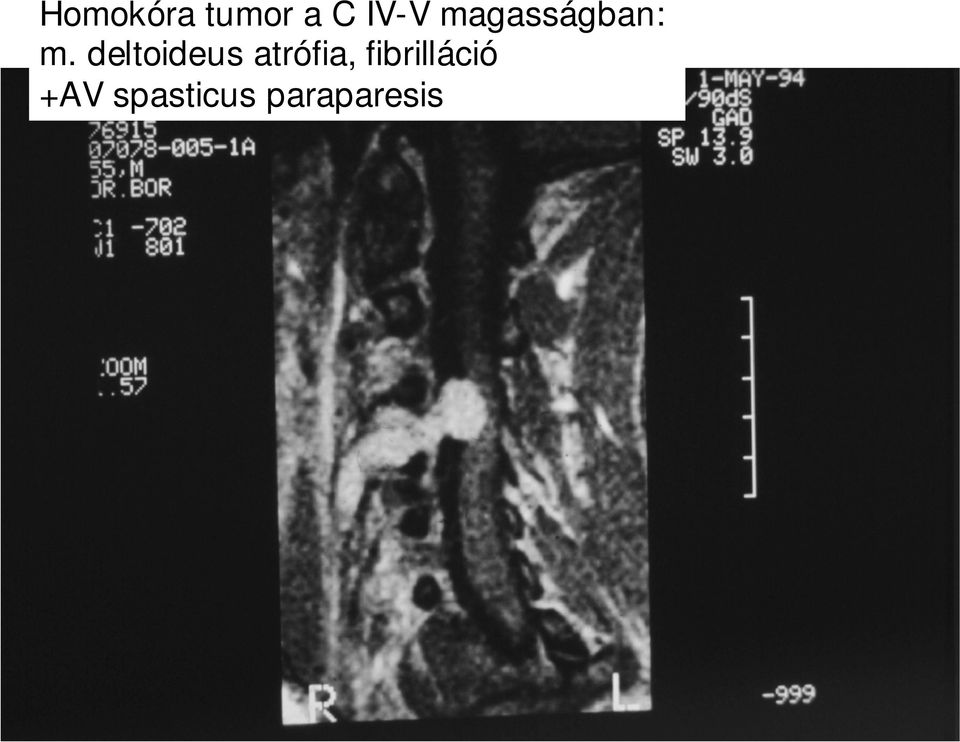 deltoideus atrófia,