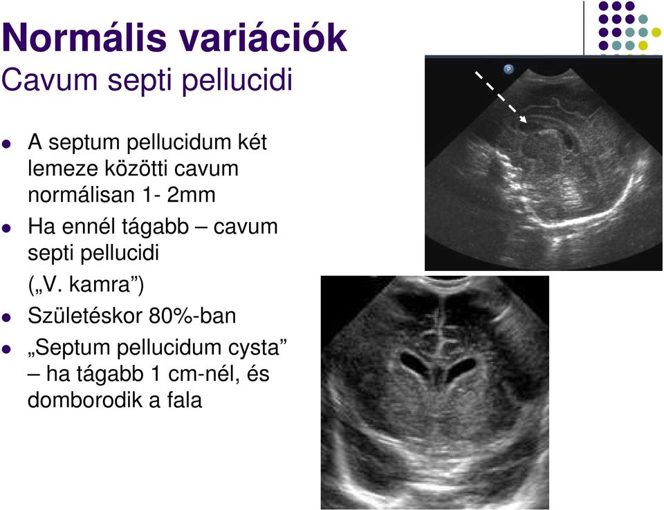 ennél tágabb cavum septi pellucidi ( V.