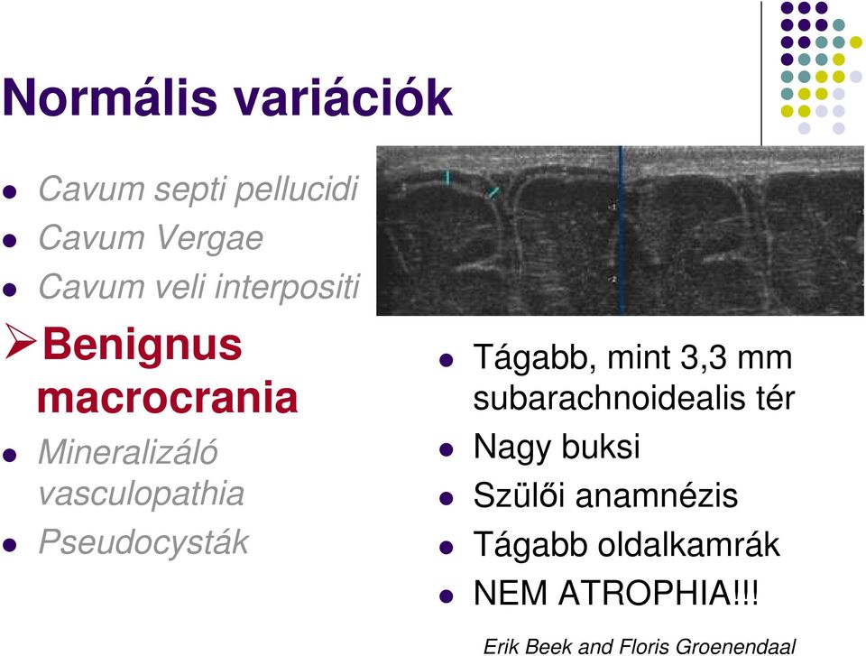 Pseudocysták Tágabb, mint 3,3 mm subarachnoidealis tér Nagy buksi