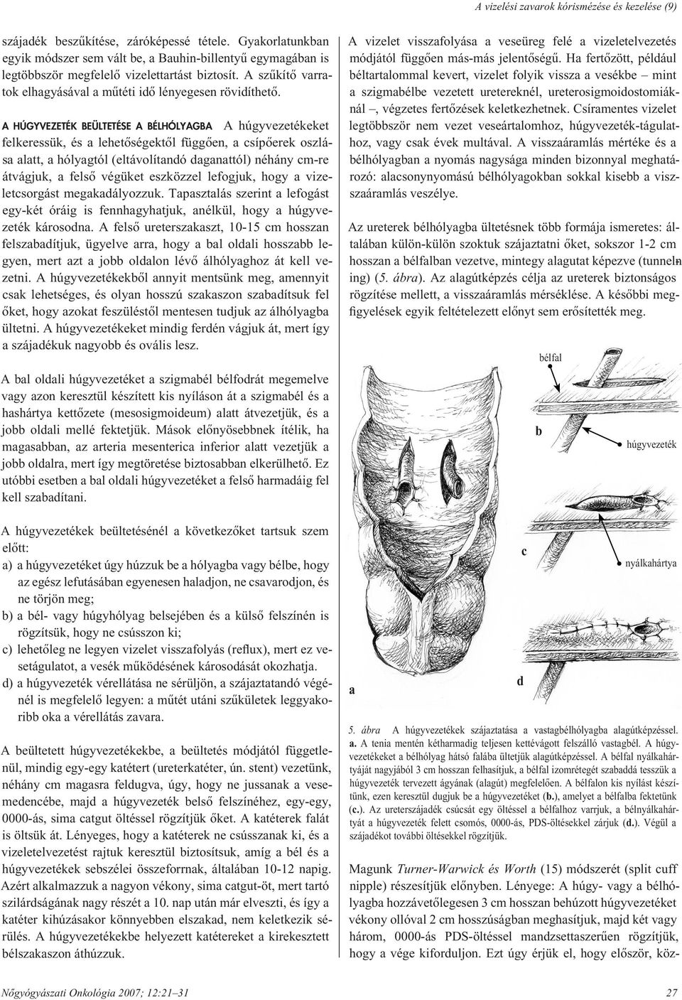 A HÚGYVEZETÉK BEÜLTETÉSE A BÉLHÓLYAGBA A húgyvezetékeket felkeressük, és a lehetôségektôl függôen, a csípôerek oszlása alatt, a hólyagtól (eltávolítandó daganattól) néhány cm-re átvágjuk, a felsô