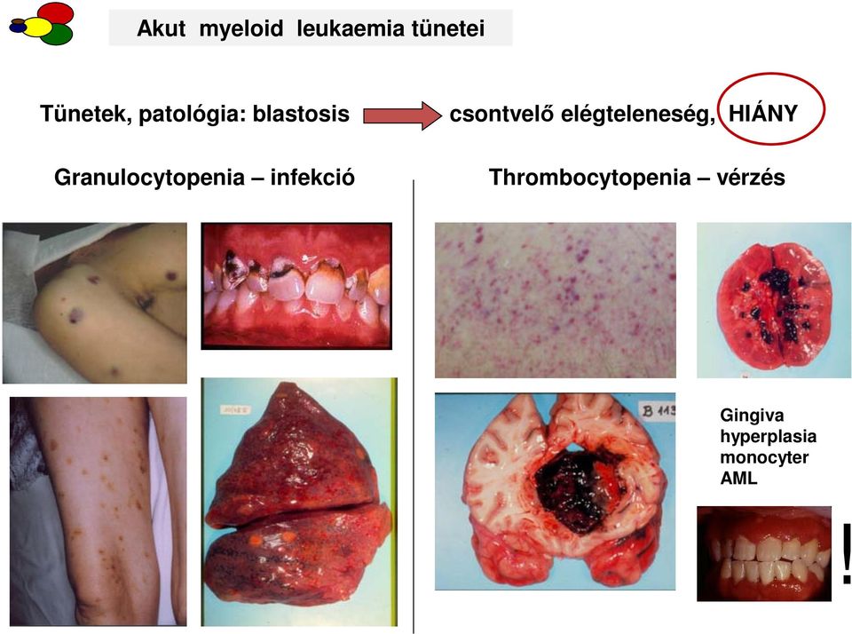 infekció csontvelő elégteleneség, HIÁNY