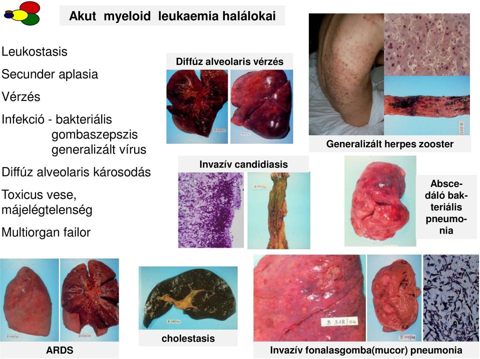 májelégtelenség Multiorgan failor Diffúz alveolaris vérzés Invazív candidiasis