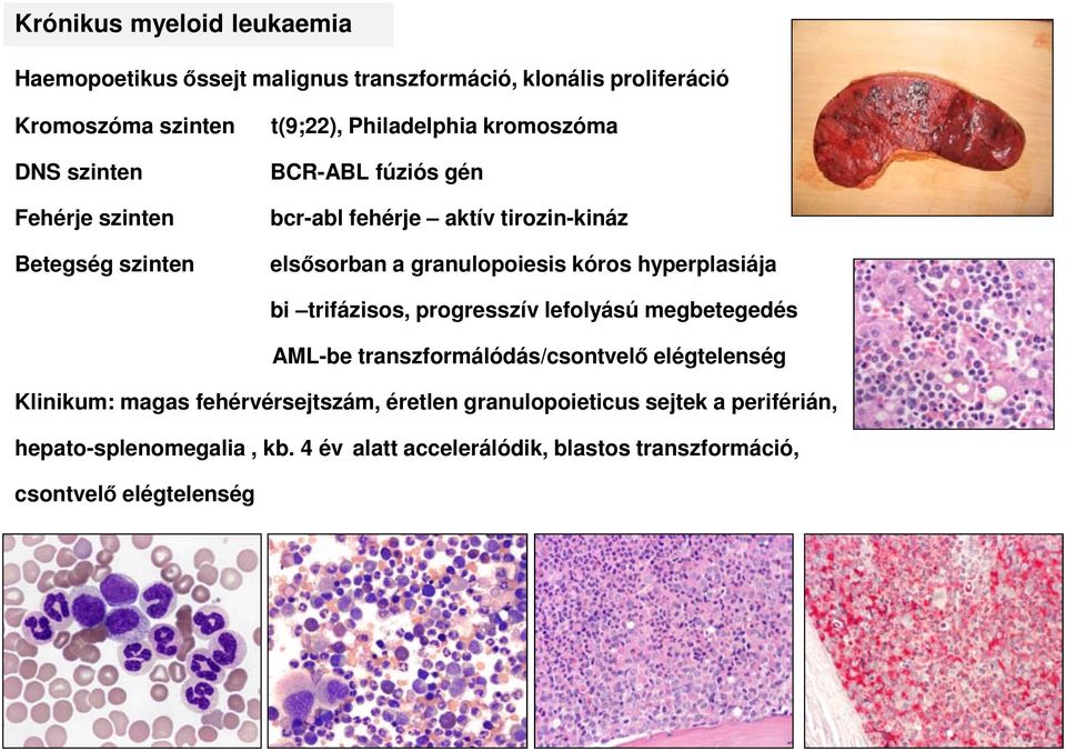 hyperplasiája bi trifázisos, progresszív lefolyású megbetegedés AML-be transzformálódás/csontvelő elégtelenség Klinikum: magas