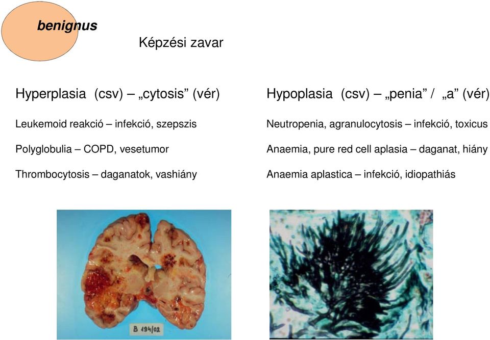 vashiány Hypoplasia (csv) penia / a (vér) Neutropenia, agranulocytosis infekció,