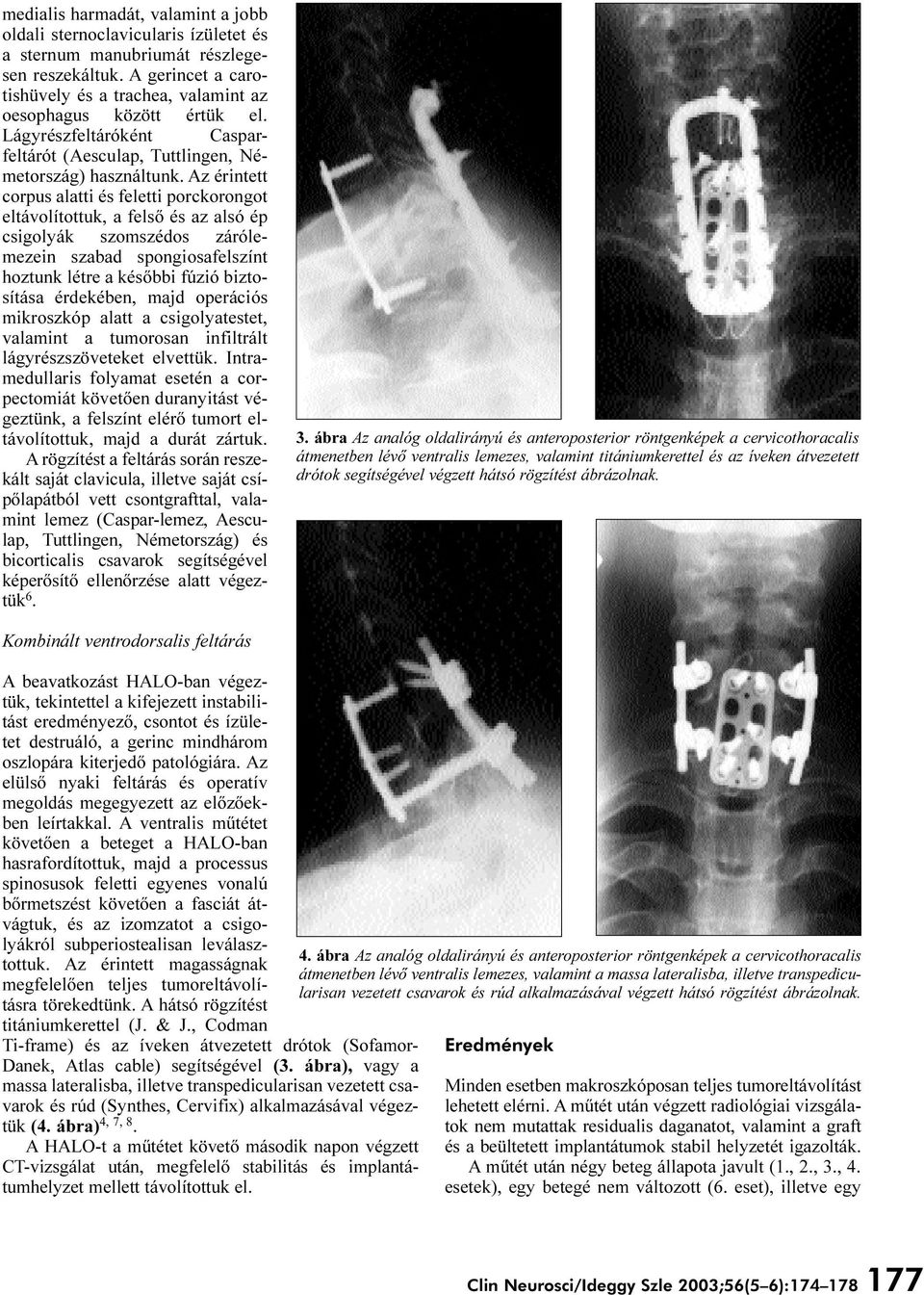 Az érintett corpus alatti és feletti porckorongot eltávolítottuk, a felsõ és az alsó ép csigolyák szomszédos zárólemezein szabad spongiosafelszínt hoztunk létre a késõbbi fúzió biztosítása érdekében,