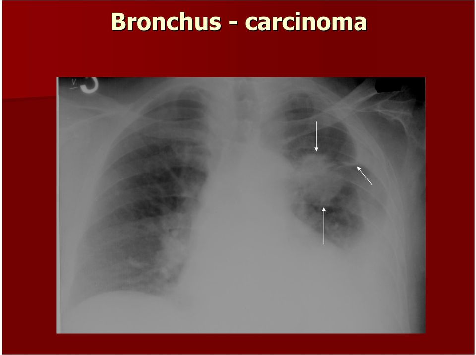 carcinoma