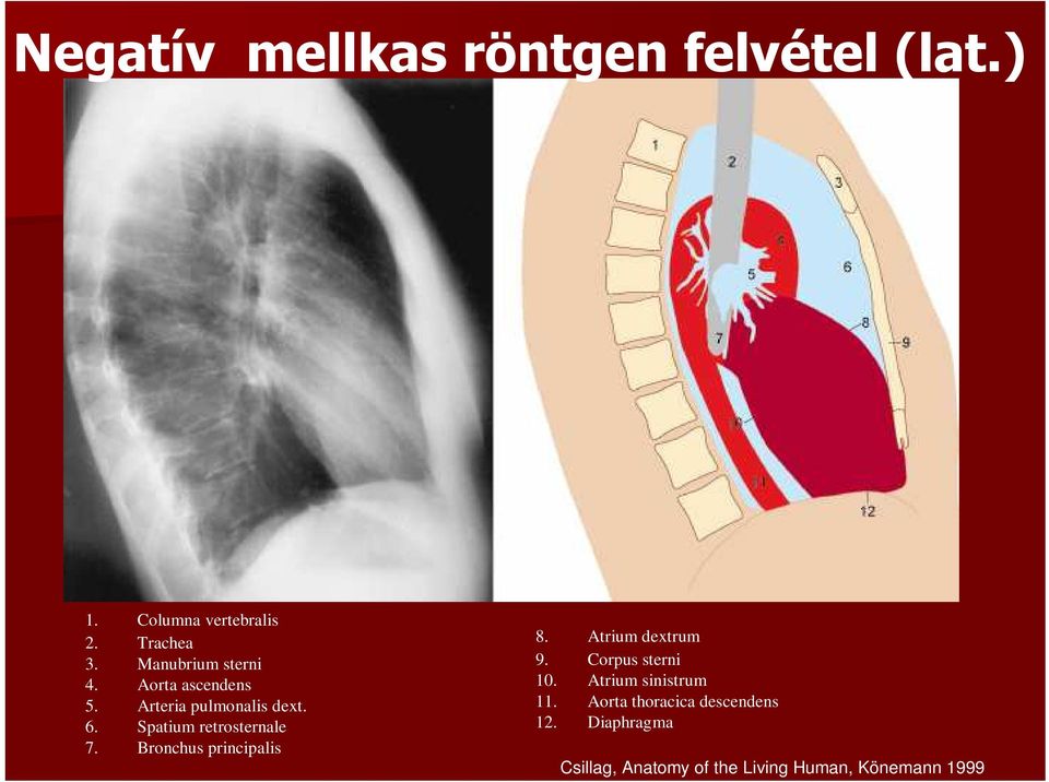 Spatium retrosternale 7. Bronchus principalis 8. Atrium dextrum 9. Corpus sterni 10.