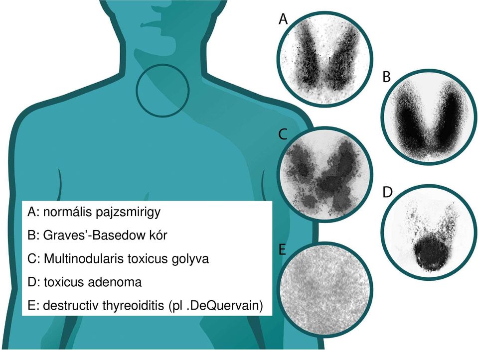 toxicus golyva D: toxicus adenoma