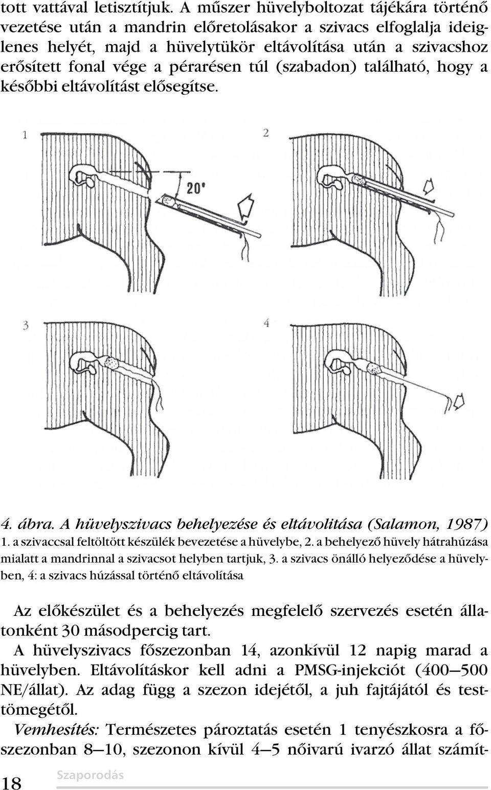 pérarésen túl (szabadon) található, hogy a későbbi eltávolítást elősegítse. 4. ábra. A hüvelyszivacs behelyezése és eltávolitása (Salamon, 1987) 1.