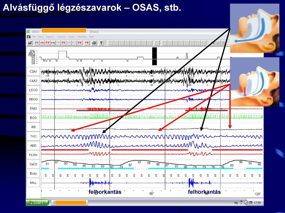 OSAS, stb.