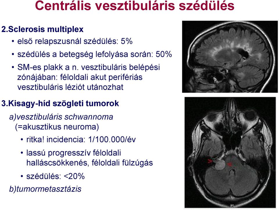 vesztibuláris belépési zónájában: féloldali akut perifériás vesztibuláris léziót utánozhat 3.