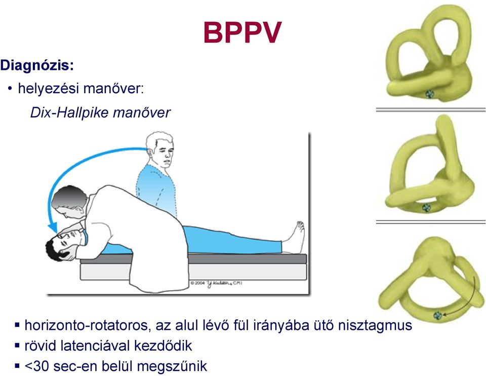 lévő fül irányába ütő nisztagmus rövid