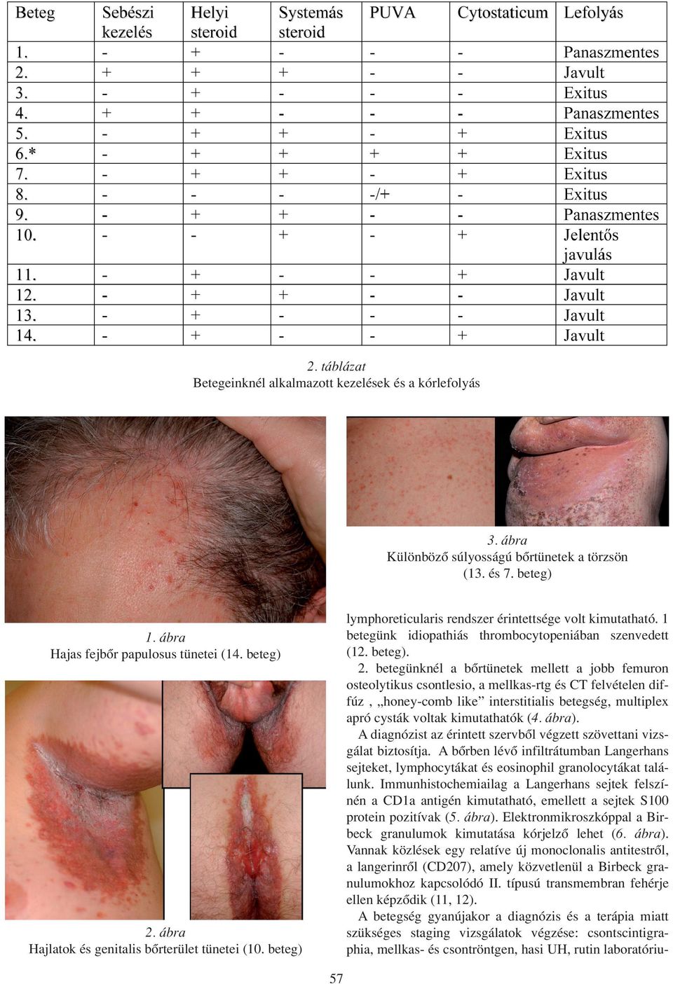 Langerhans sejtes histiocytosis felnôttkorban* Langerhans cell histiocytosis  in adults - PDF Ingyenes letöltés