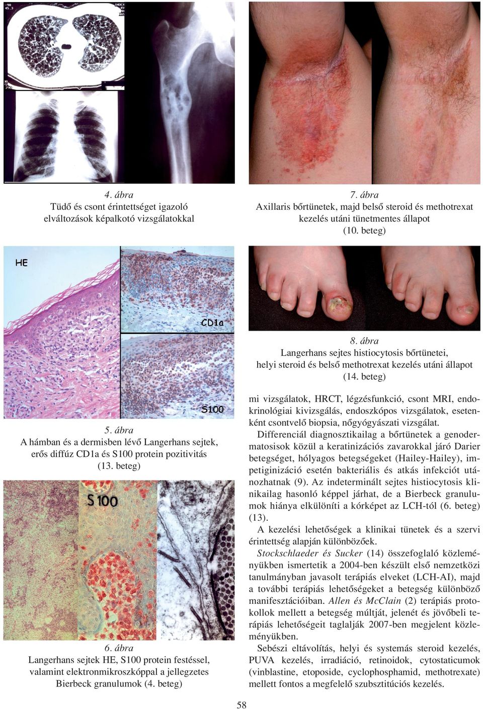 beteg) mi vizsgálatok, HRCT, légzésfunkció, csont MRI, endokrinológiai kivizsgálás, endoszkópos vizsgálatok, esetenként csontvelô biopsia, nôgyógyászati vizsgálat.