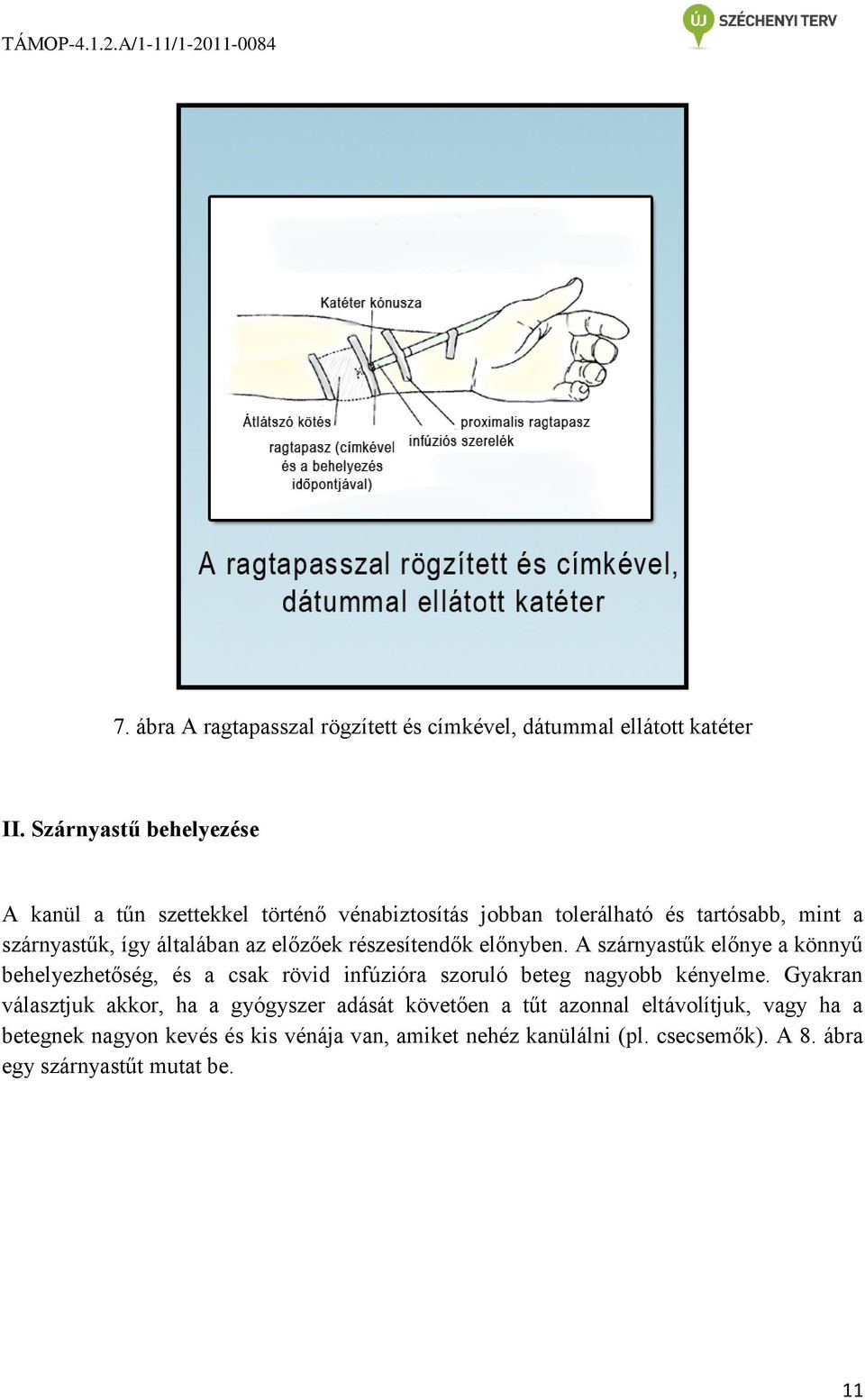 előzőek részesítendők előnyben. A szárnyastűk előnye a könnyű behelyezhetőség, és a csak rövid infúzióra szoruló beteg nagyobb kényelme.