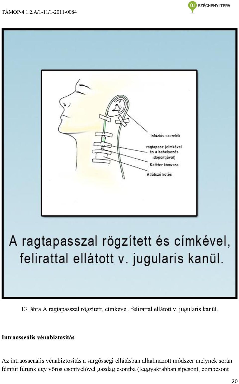 Intraosseális vénabiztosítás Az intraosseaális vénabiztosítás a