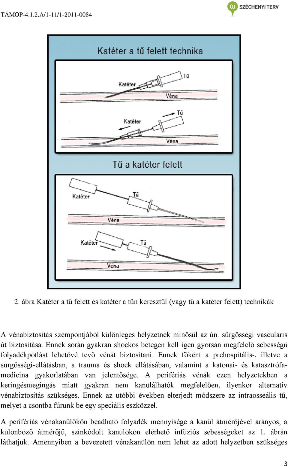 A fejezet célja Alapfogalmak Bevezetés I. Katéter a tűn technika II.  Szárnyastű behelyezése PDF Free Download