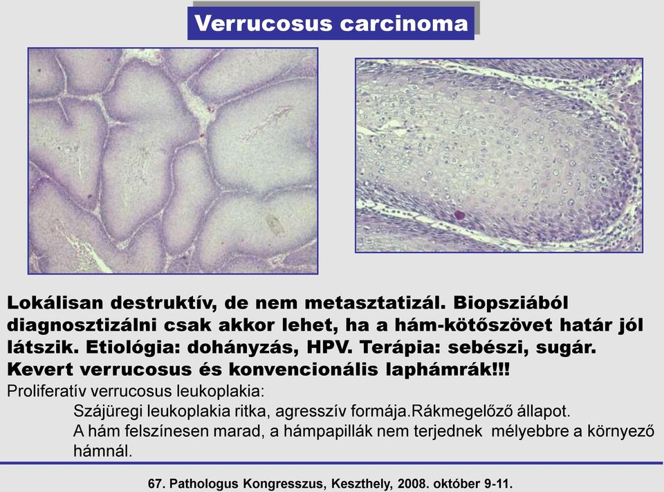 Etiológia: dohányzás, HPV. Terápia: sebészi, sugár. Kevert verrucosus és konvencionális laphámrák!