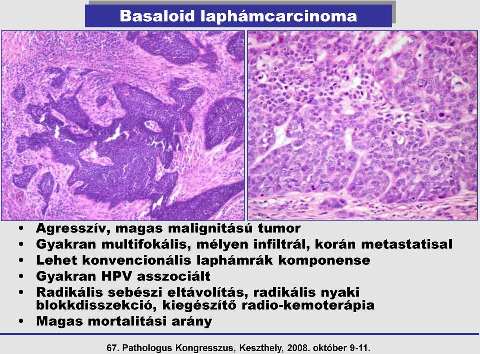 laphámrák komponense Gyakran HPV asszociált Radikális sebészi eltávolítás,