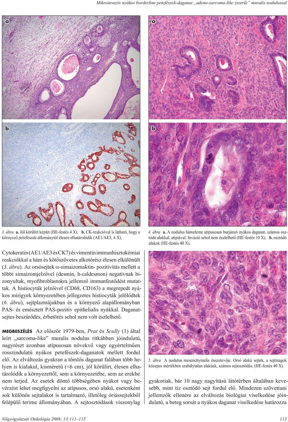 Cytokeratin (AE1/AE3 és CK7) és vimentin immunhisztokémiai reakciókkal a hám és kötôszövetes alkotórész élesen elkülönült (3. ábra).