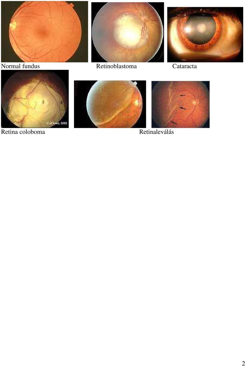 Cataracta Retina