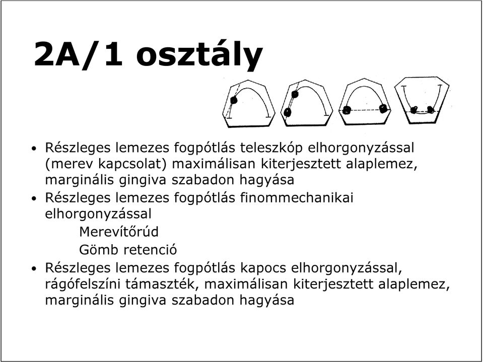 finommechanikai elhorgonyzással Merevítőrúd Gömb retenció Részleges lemezes fogpótlás kapocs